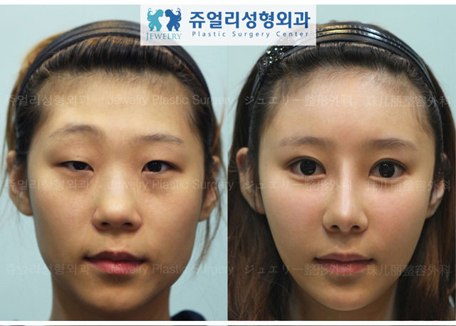 before_and_after_photos_of_korean_plastic_surgery_part_2_640_50.jpg