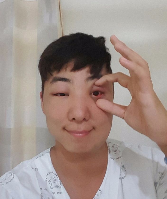 염색약 알러지 그 이후..._5.jpg