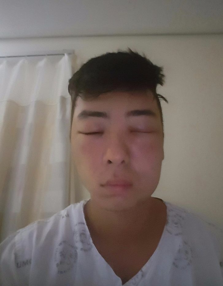 염색약 알러지 그 이후..._4.jpg
