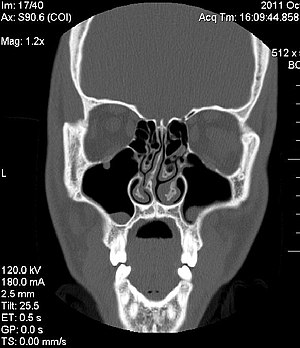 300px-Deviated_Septum_CT_Scan.jpg