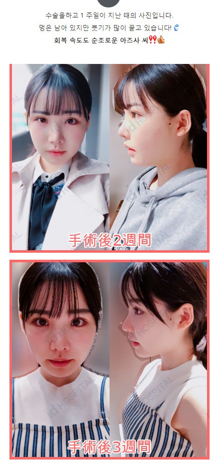 한국 성형외과에서 수술받은 AV배우_5.jpg