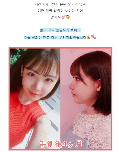 한국 성형외과에서 수술받은 AV배우_6.jpg
