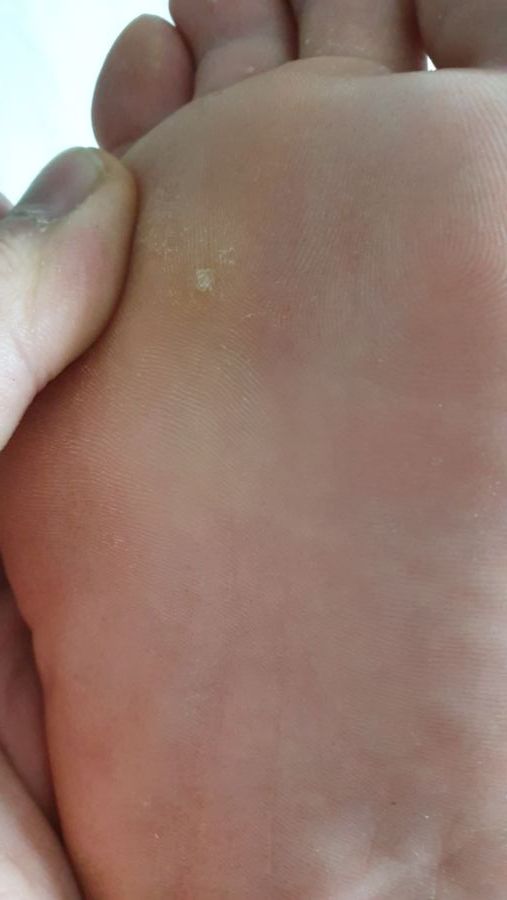 혐)티눈밴드 많이써본 유게이있냐_1.jpg