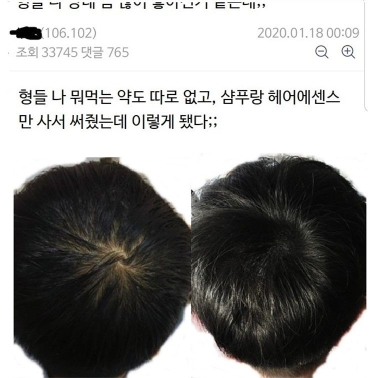 탈모갤 맥주효모빌런_1.jpg