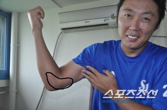 투수의 팔에서 나오는 뼛조각_1.jpg