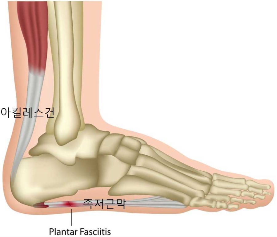 Plantar-fasciitis.jpg