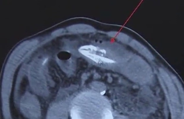 변비 고쳐보겠다고 20cm길이 장어를 산채로 항문에 쑥 넣은 남자_1.jpg