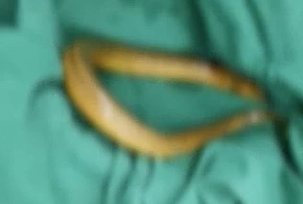 변비 고쳐보겠다고 20cm길이 장어를 산채로 항문에 쑥 넣은 남자_3.jpg