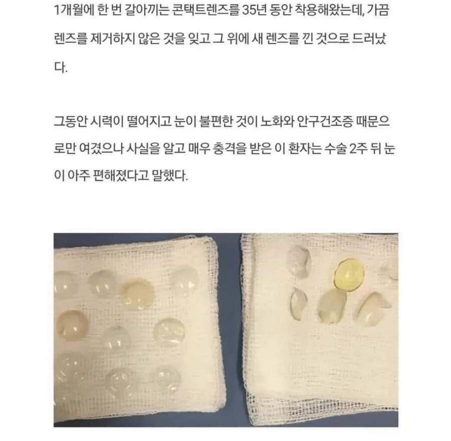 67세 할머니 눈에서 나온것.jpg_2.jpeg