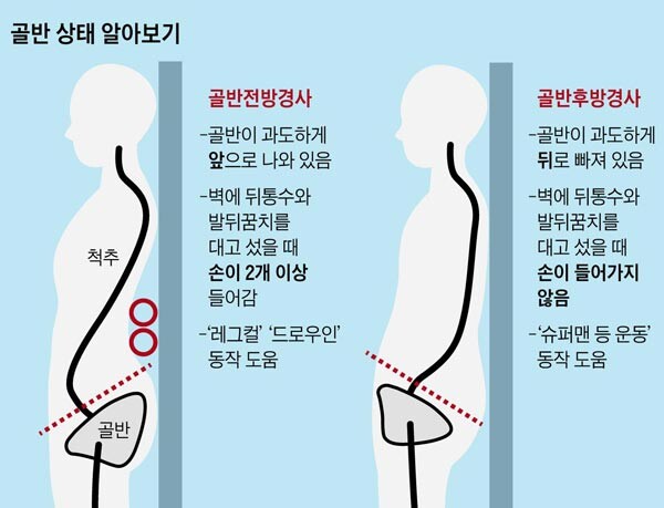 오리궁뎅이 허리통증 봐라 골반전방경사
