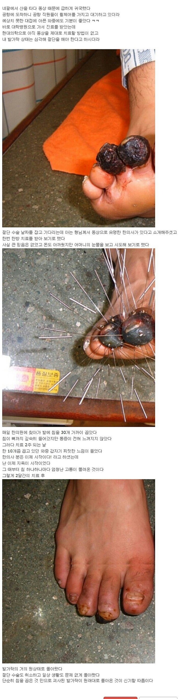 침술의 과학적 근거 (혐짤주의)_1.jpg