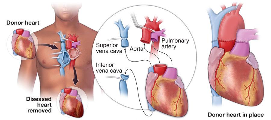 heart-transplant-illustration_0.jpg