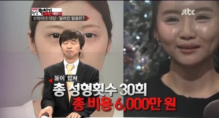 얼굴성형 30번. 과도한 수술의 결과물_11.png