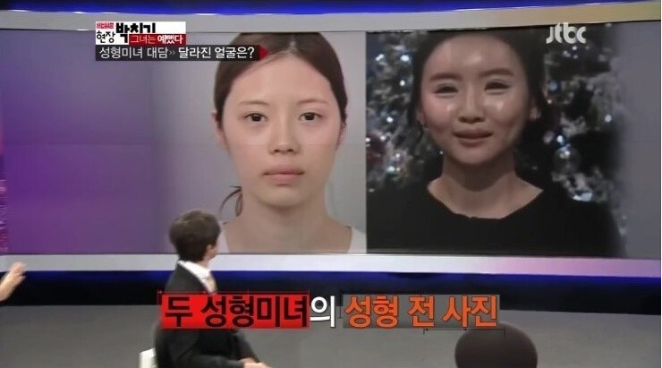 얼굴성형 30번. 과도한 수술의 결과물_5.png