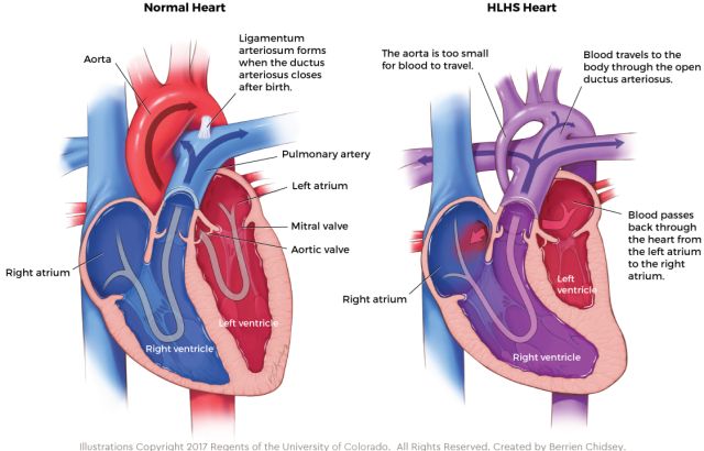 normal-vs-hlhs-anatomy.jpg