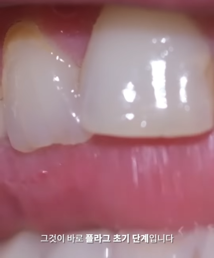 한달동안 이를 닦지 않으면 생기는 일_7.png