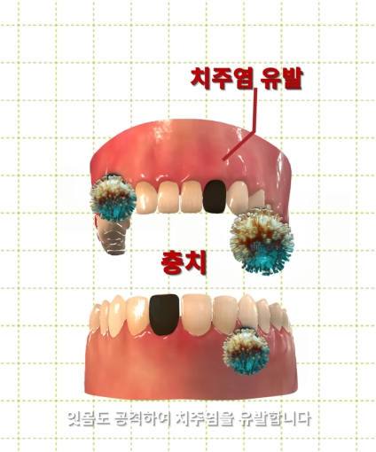 한달동안 이를 닦지 않으면 생기는 일_17.png