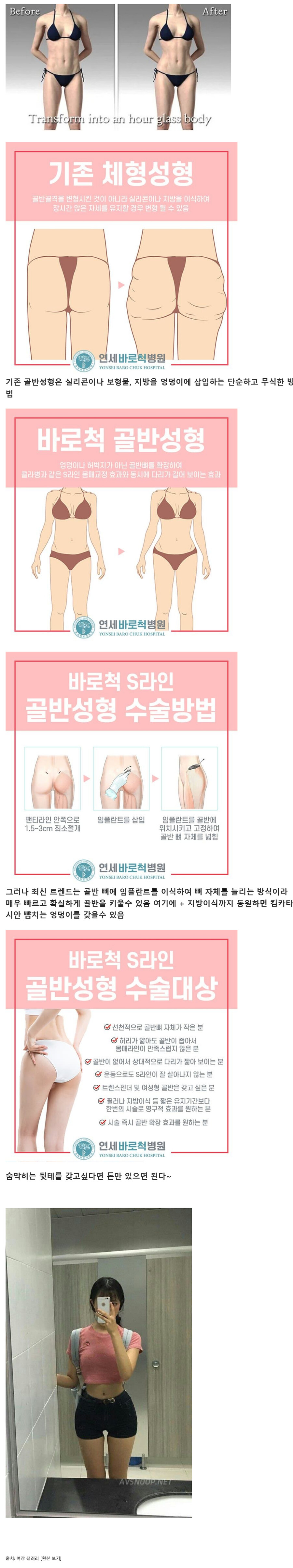 avsnoop 고딩 발 서양 골반을 만들어주는 성형수술jpg