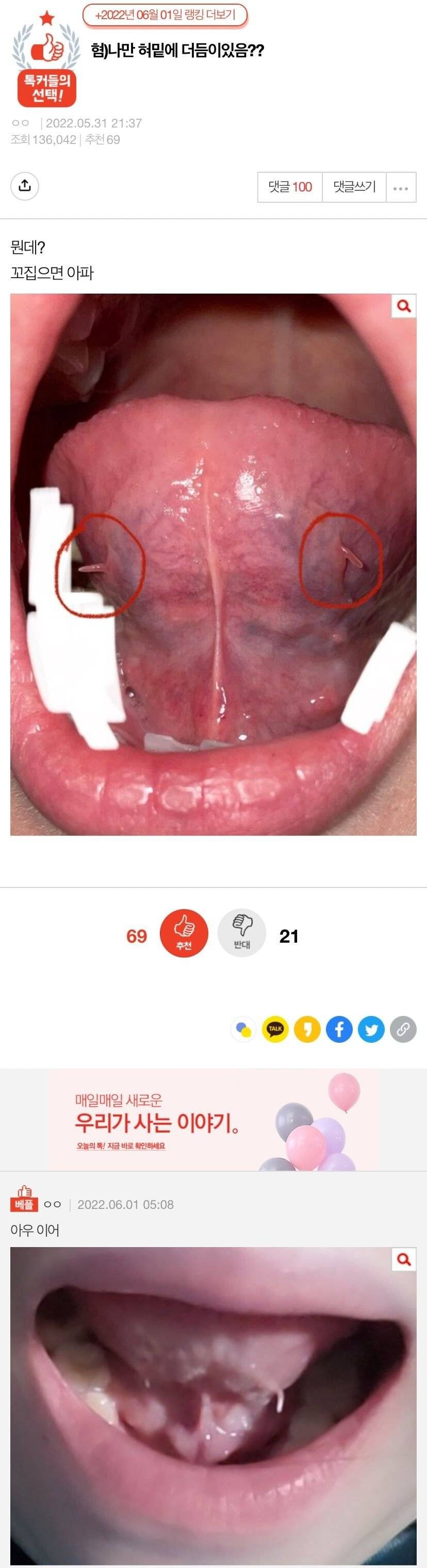 혀 밑에 촉?수 이거 남들 다 가지고 있어?.jpg