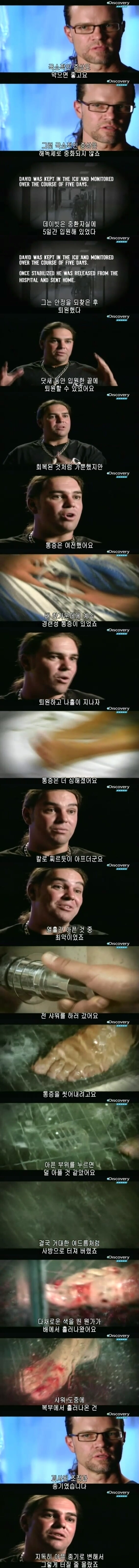 [극혐] 코브라한테 물려서 몸에 구멍이 생긴 남자.jpg_9.jpg