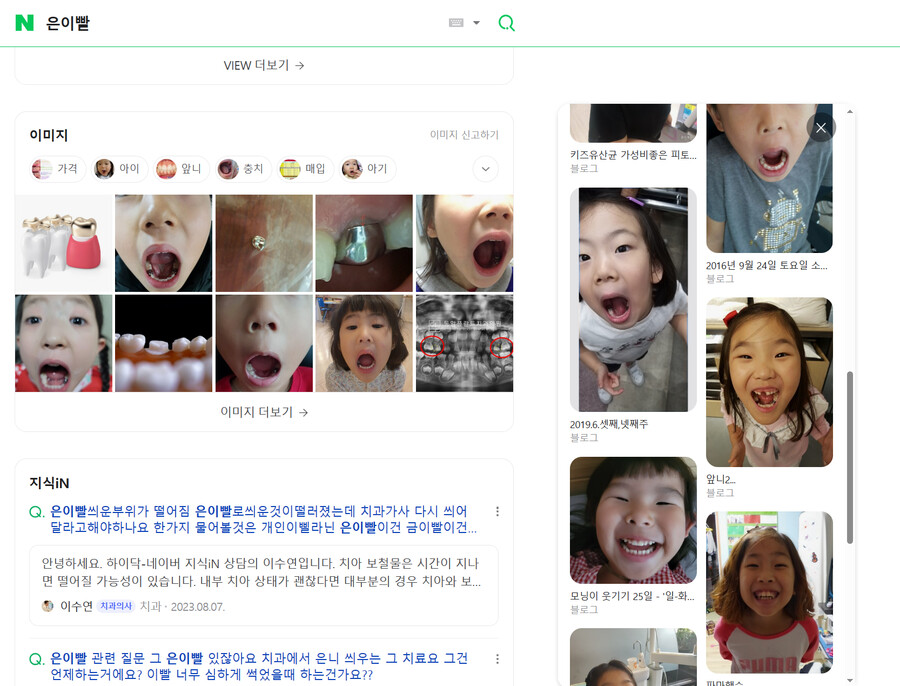 금이빨 은이빨 차이_2.png