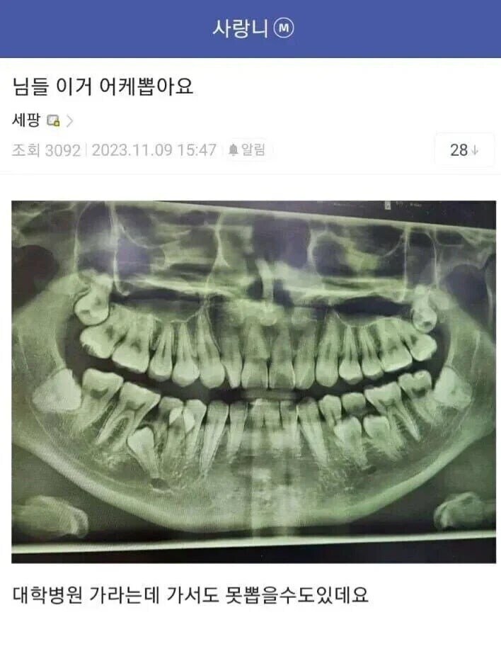사랑니 레전드 수술 전후_1.jpg