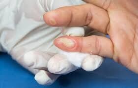 의사들이 말하는 손에 화상입고 물집 생길때 대처법.._2.jpg