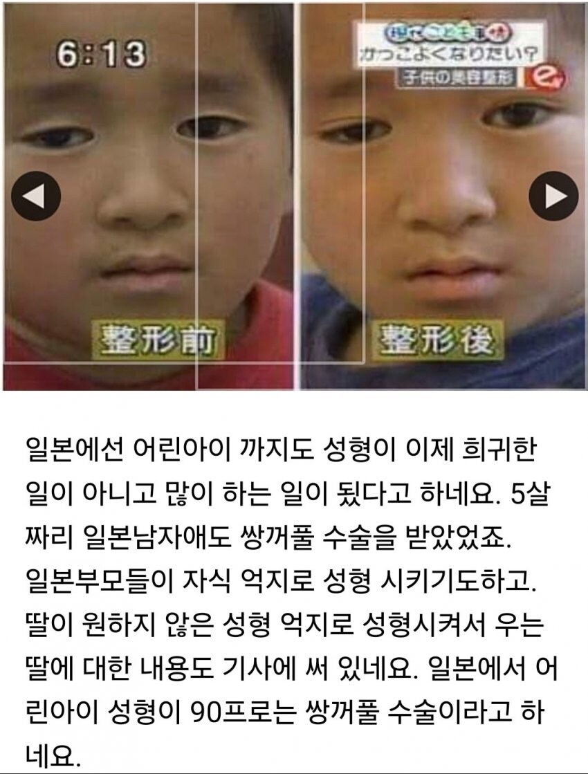 성형수술 받은 일본 초등학생.jpg_6.jpg