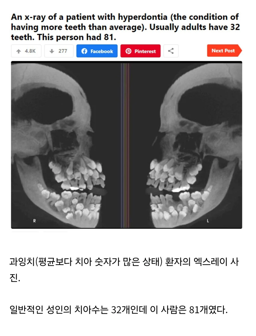 약혐) 과잉치 레전드.jpg_1.webp