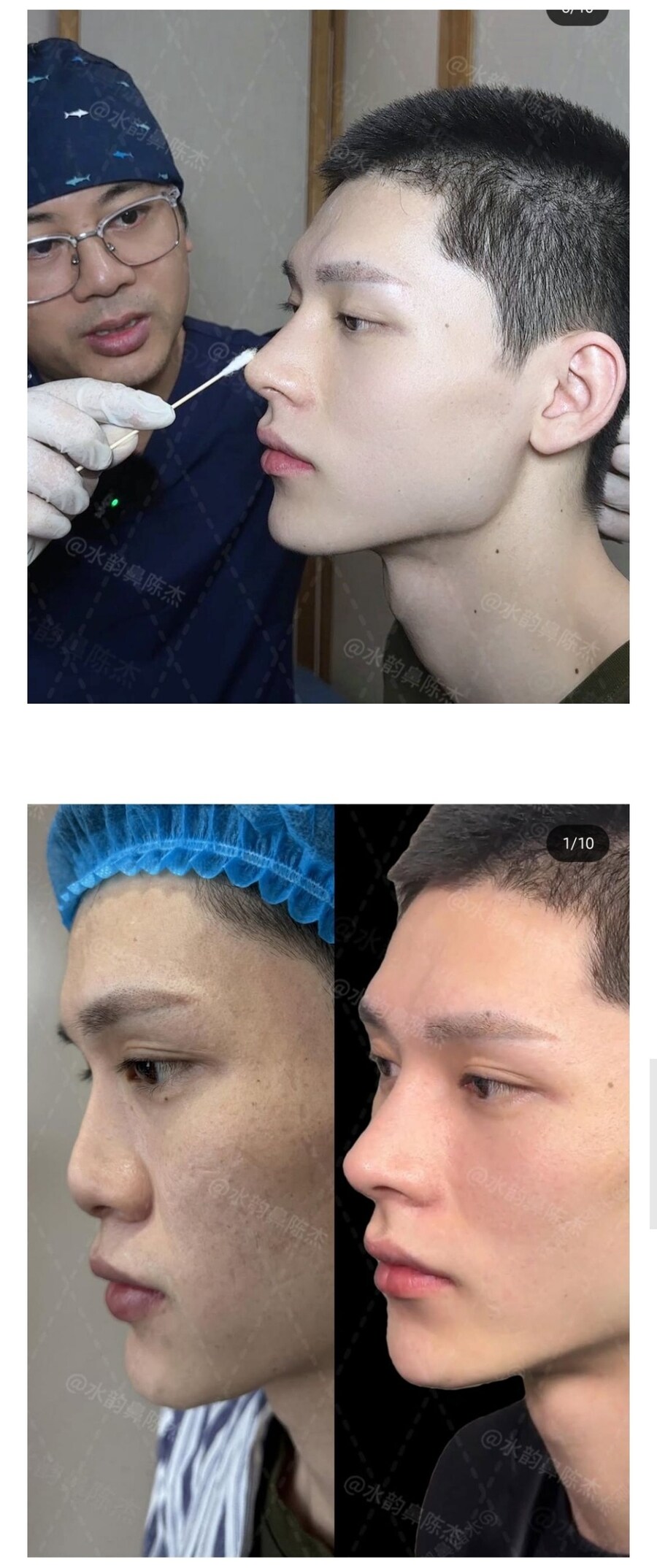 남자 코수술 레전드_2.jpg