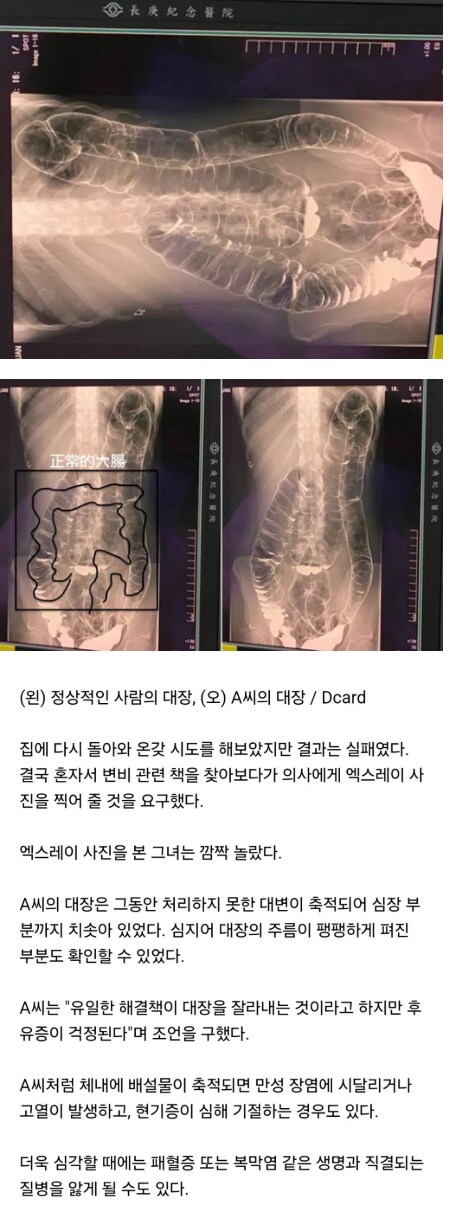 변비때문에 17일동안 화장실 못 간 사람 엑스레이 사진_1.png