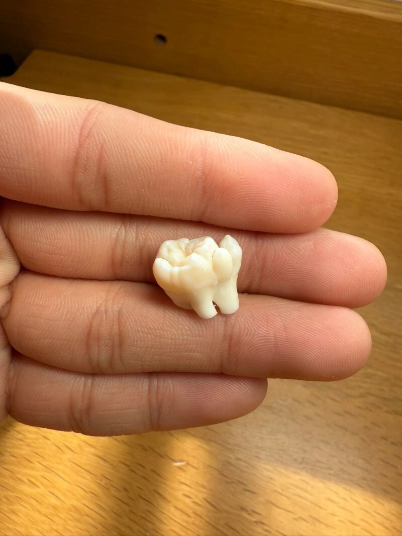 치과의사들: 이건 꼭구경 해야하는 사랑니다!!_2.jpg