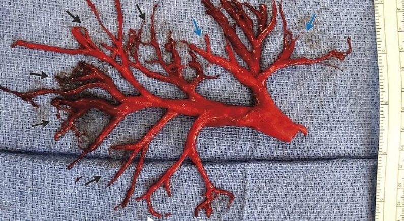 혐주의) 폐가 아픈 사람이 기침하다가 뱉어낸 혈전 덩어리.jpg_1.jpg