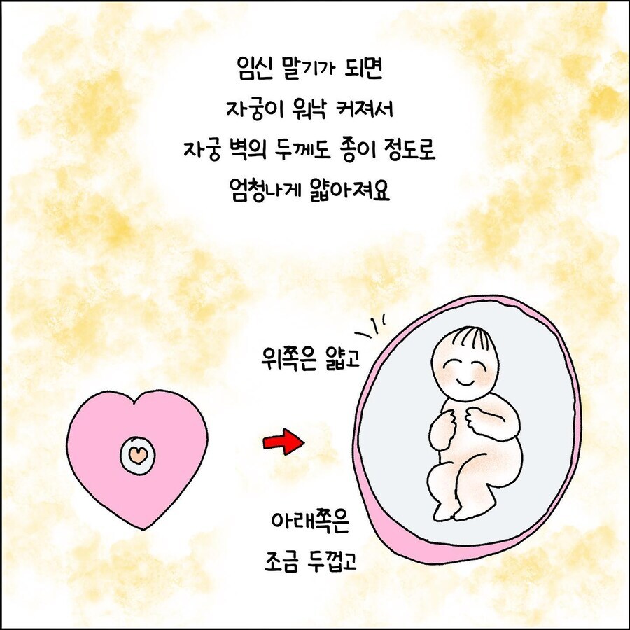 산부인과에서 출산 중 자궁파열 되는 만화.jpg_2.jpg