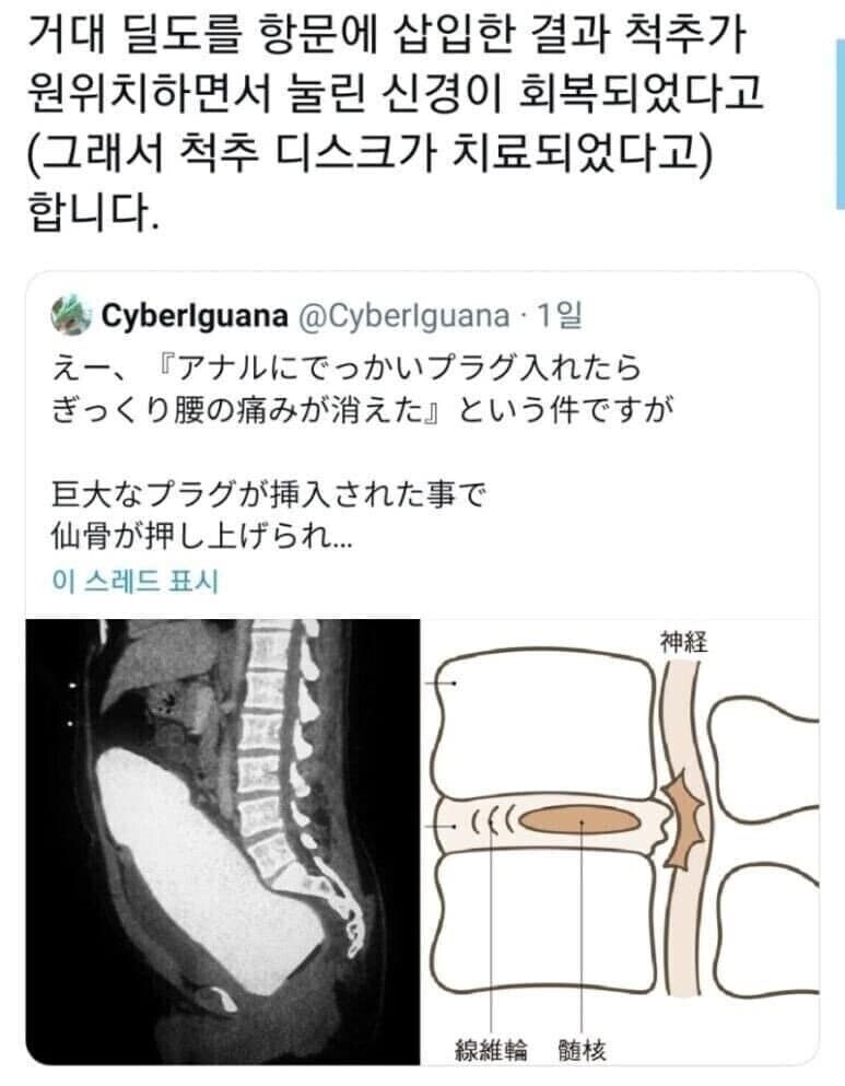역사)의외로 치료목적으로 시작되었던 성인용품_3.jpg