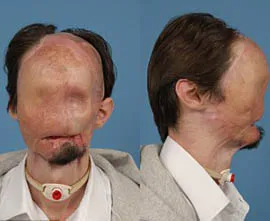 페이스 오프 수술 전후(혐짤있음)_1.webp