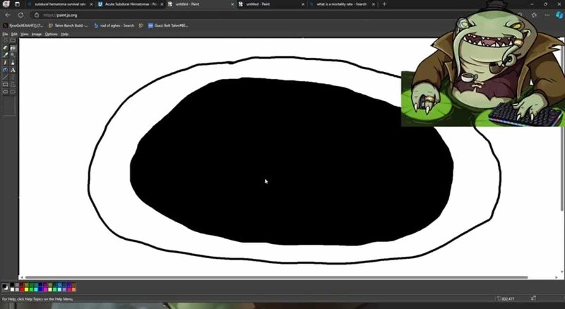 뇌 수술 후 실명한 스트리머가 롤 마스터 복귀함_3.jpg