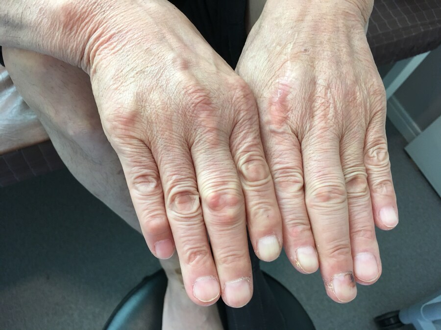 혐)통풍의 메커니즘_4.png