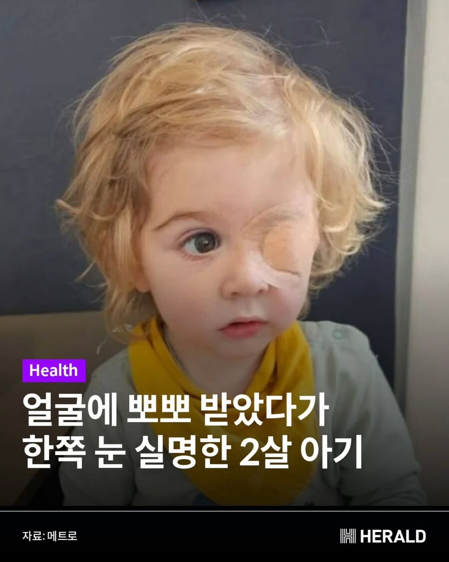 뽀뽀받고 실명해버린 만1세 아기_1.jpg