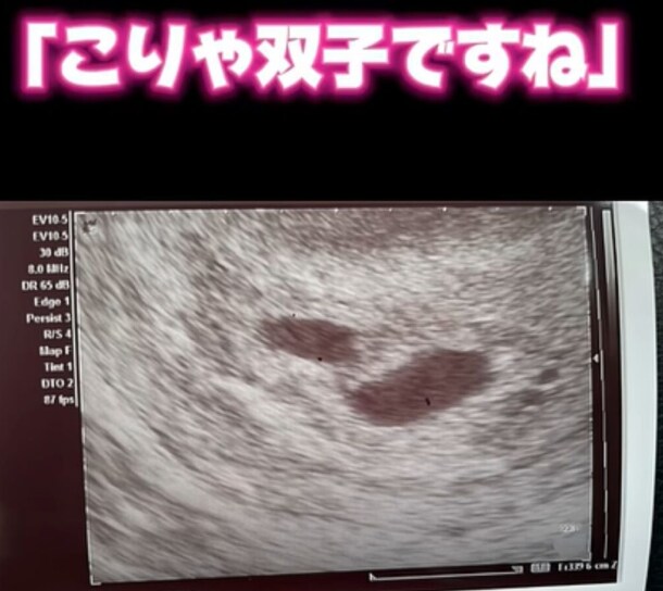 쌍둥이 임신 소식에 기뻣던 엄마 근황., jpg_1.png