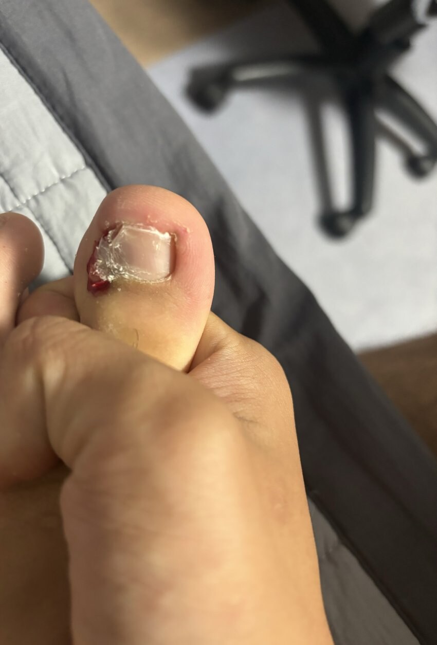 혐) 내성발톱_2.jpg