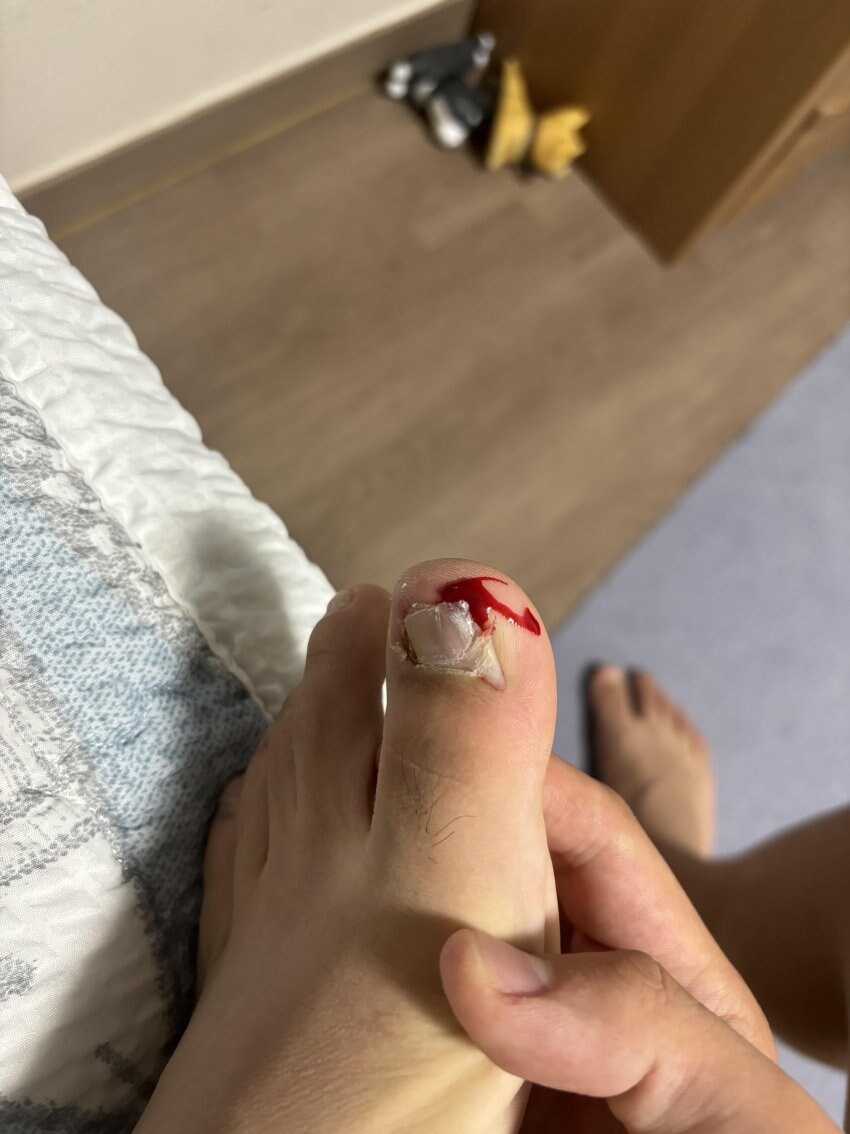 혐) 내성발톱_3.jpg