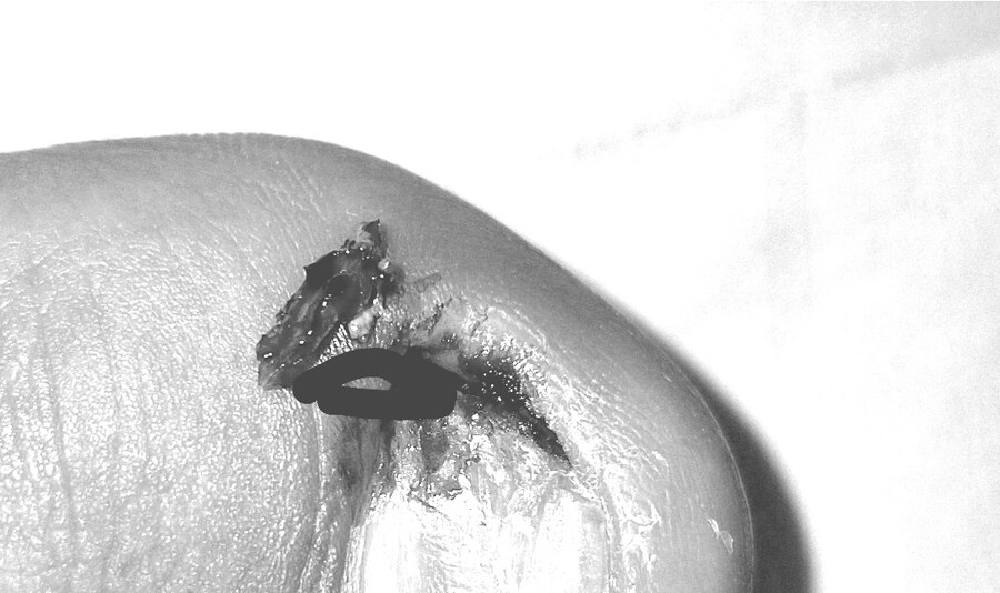 혐) 내성발톱 모음집_7.jpg