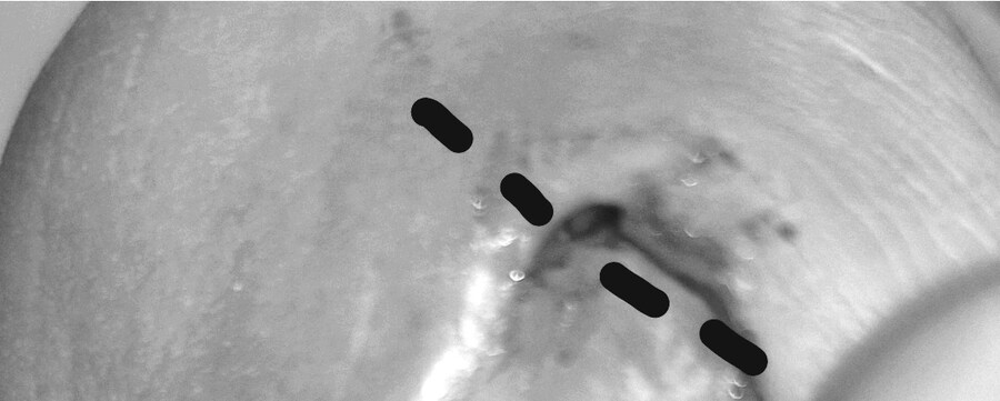 혐) 내성발톱 모음집_9.jpg