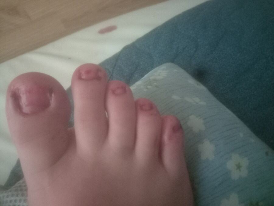 혐) 내성발톱 모음집_2.jpg