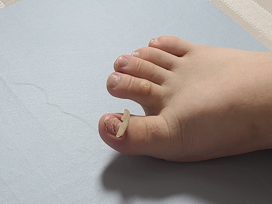 혐) 내성발톱 모음집_5.jpg