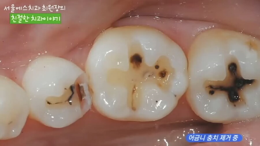 충치 치료 과정.jpg_2.jpg