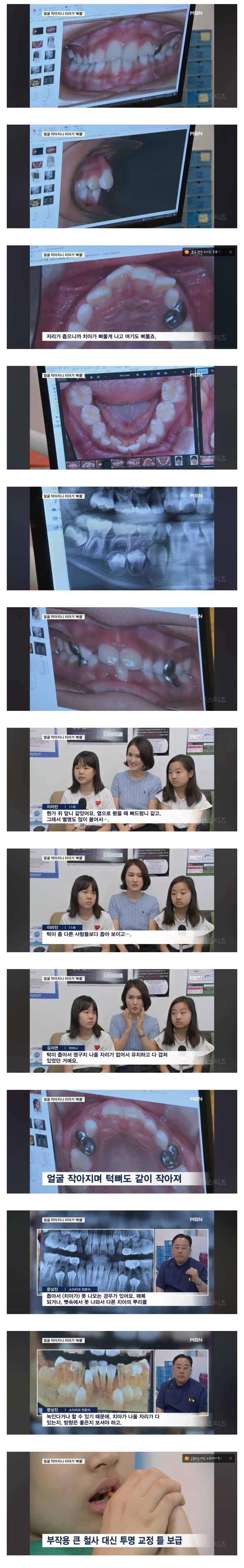 얼굴이 작아져서 치아가 기형으로 나고있다는 요즘 애들.jpg_1.jpg