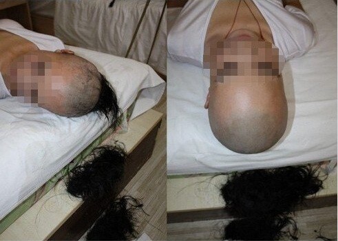 원나잇 후 여자를 대머리로 만든 남자_1.jpg
