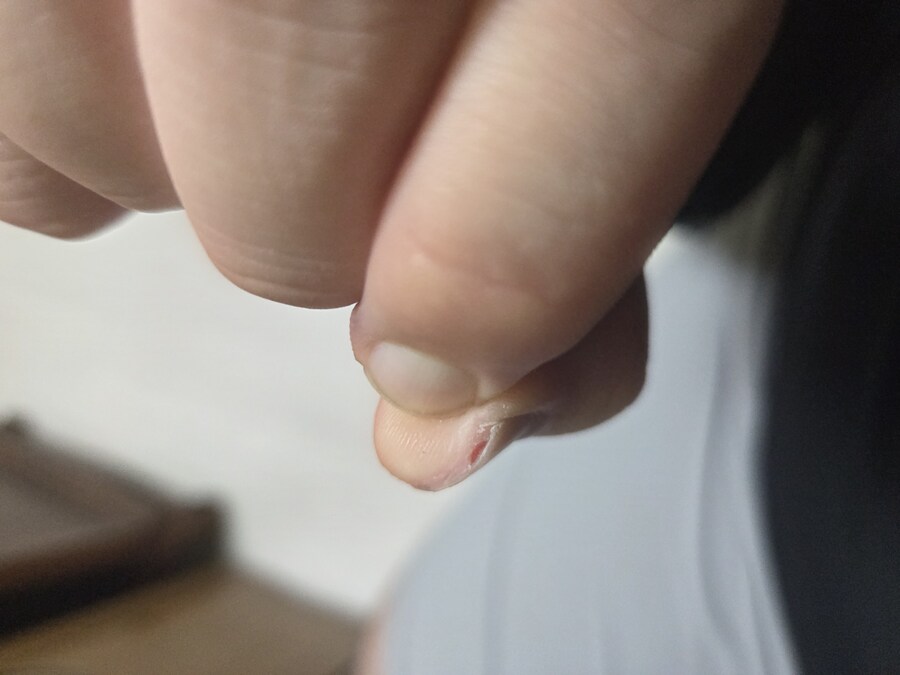 손톱 조심히 깍아야 하는 이유_1.jpg
